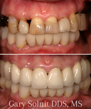 Full Mouth Reconstruction | Beverly Hills Prosthodontist