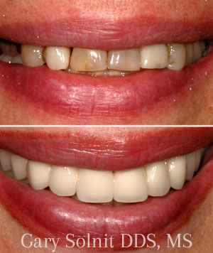 Porcelain Veneers Beverly Hills