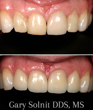 Porcelain Veneers Beverly Hills