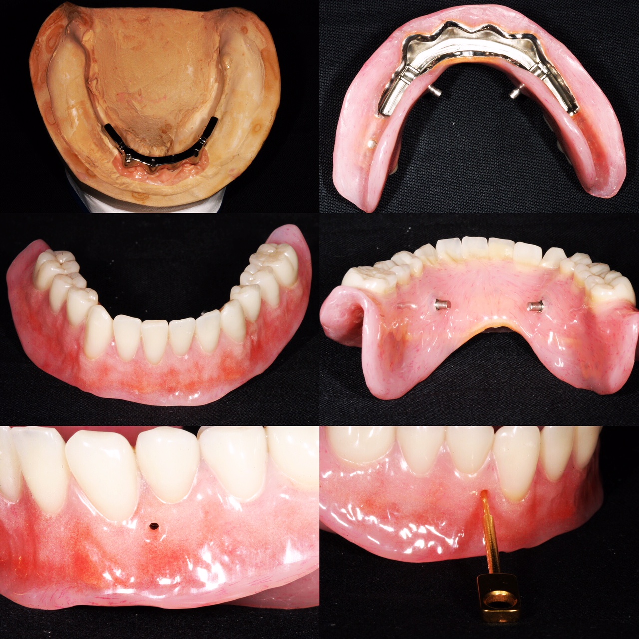 Prosthetic Dentist, Implant Supported Overdentures, Beverly Hills